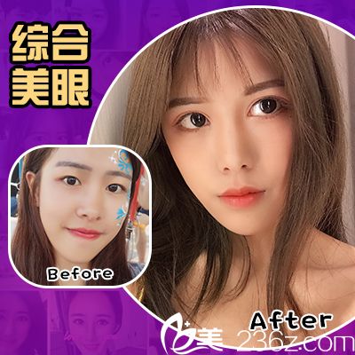 廣州美萊眼綜合案例