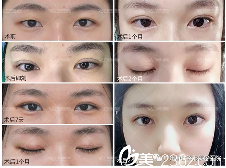 廣州博仕仿生理雙眼皮多少錢？張建軍給出仿生雙眼皮及雙眼皮修復(fù)案例價(jià)格表