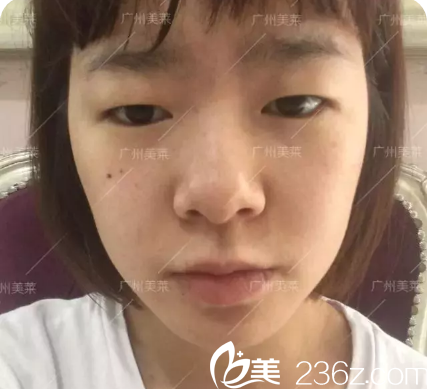 術前單眼皮照片 術前單眼皮照片