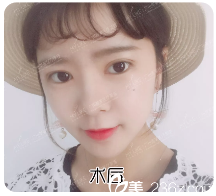 廣州美萊陳貴宗做雙眼皮怎么樣 廣州美萊陳貴宗做雙眼皮怎么樣