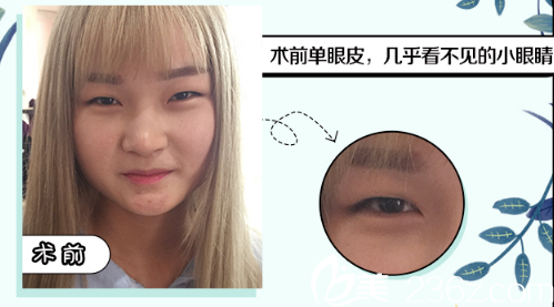 單眼皮術前照 單眼皮術前照