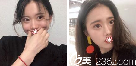 貴陽甲秀整形雙眼皮術(shù)后2個月 貴陽甲秀整形雙眼皮術(shù)后2個月