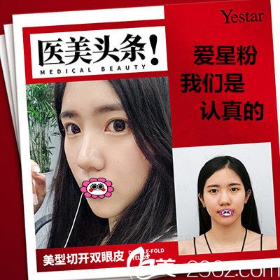 溫州藝星全切雙眼皮效果圖