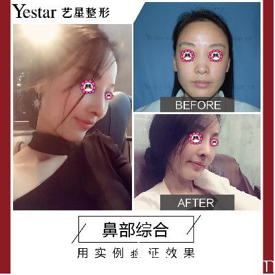 溫州藝星譚立文院長鼻綜合對比圖