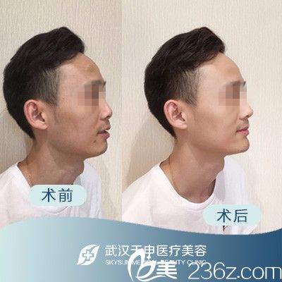 武漢天申整形假體下巴前后對(duì)比案例