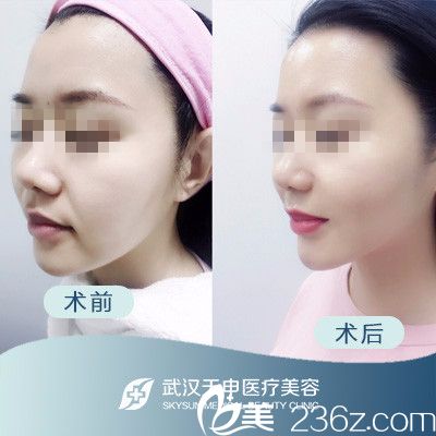 武漢天申整形埋線提升前后對(duì)比案例