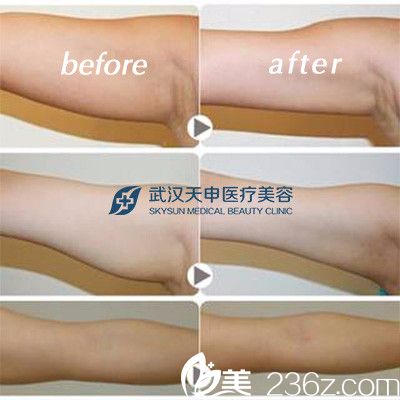 武漢天申整形吸脂前后對(duì)比案例