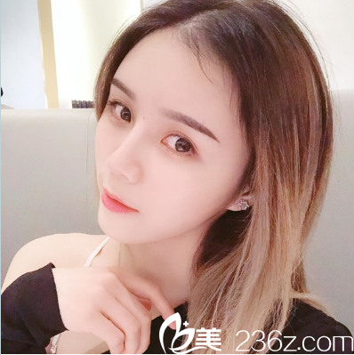 廣州曙光萬友望全臉脂肪填充案例