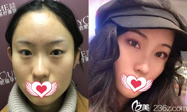 <!--<i data=20240703-sp></i>-->眼鼻綜合整形案例前后效果對(duì)比圖