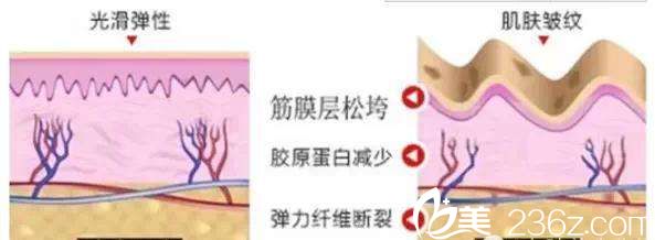 除皺效果 除皺效果