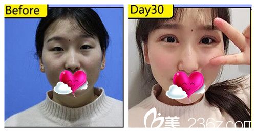 看常熟時代整形割雙眼皮怎么樣