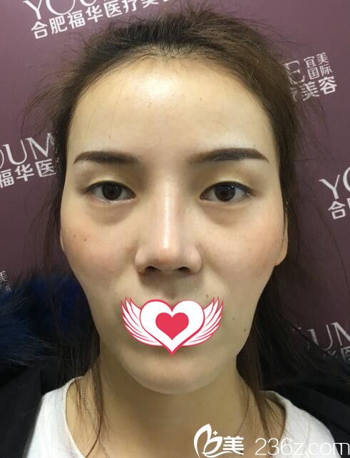 合肥福華整形眼鼻綜合+自體脂肪面部填充前樣子 合肥福華整形眼鼻綜合+自體脂肪面部填充前樣子