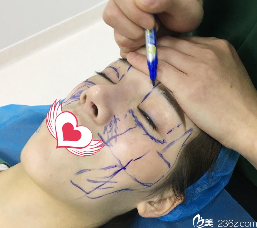 趙章杰自體脂肪全臉填充術(shù)前設(shè)計(jì)方案 趙章杰自體脂肪全臉填充術(shù)前設(shè)計(jì)方案