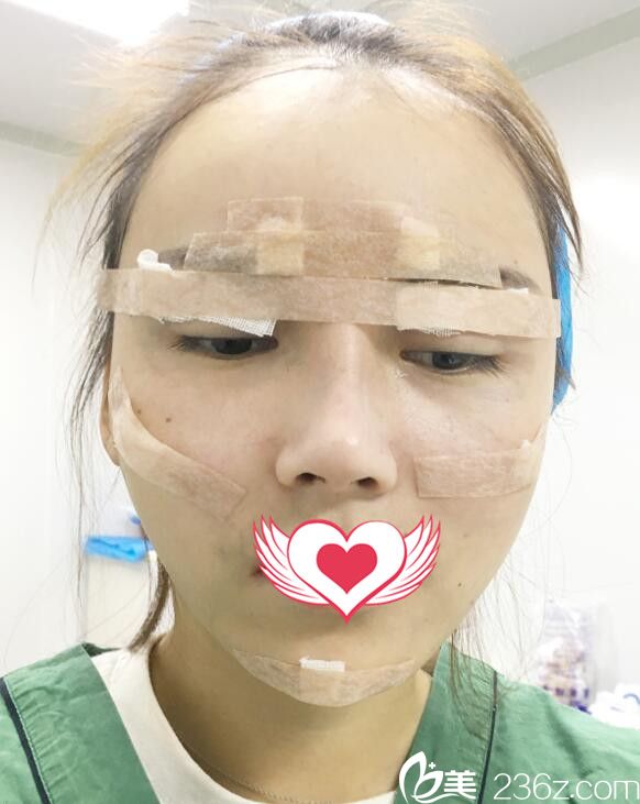 去合肥福華整形做面部填充自體脂肪即刻效果 去合肥福華整形做面部填充自體脂肪即刻效果