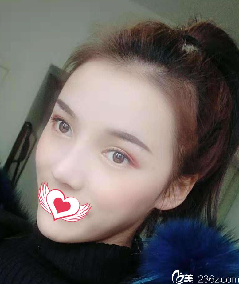 找趙章杰做眼鼻綜合+自體脂肪填充1個(gè)月效果圖 找趙章杰做眼鼻綜合+自體脂肪填充1個(gè)月效果圖