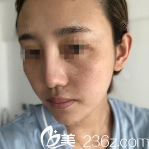 在吉林國健做面部自體脂肪填充前 在吉林國健做面部自體脂肪填充前