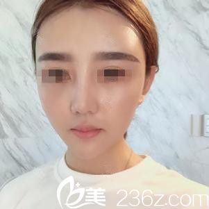 在吉林國健做面部自體脂肪填充術(shù)后1個月 在吉林國健做面部自體脂肪填充術(shù)后1個月