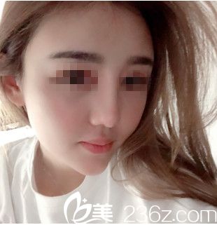 脂肪填充需要多次？看我在吉林國(guó)健只做了一次脂肪填充面頰就很飽滿