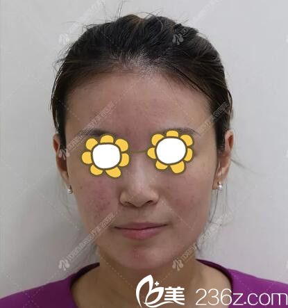 果酸換膚術(shù)后即刻效果 果酸換膚術(shù)后即刻效果