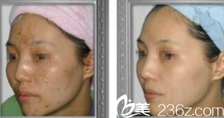 激光祛斑真人案例 激光祛斑真人案例