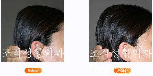 慘痛經(jīng)歷！三位后腦勺額頭骨水泥填充頭部整形妹子訴苦自己積攢多年的心酸