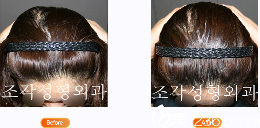 韓國雕刻醫(yī)院左右不對稱后腦勺整形 韓國雕刻醫(yī)院左右不對稱后腦勺整形