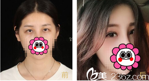 北京京通整形開眼角整形優(yōu)惠進(jìn)行中！開眼角價(jià)格3800元起