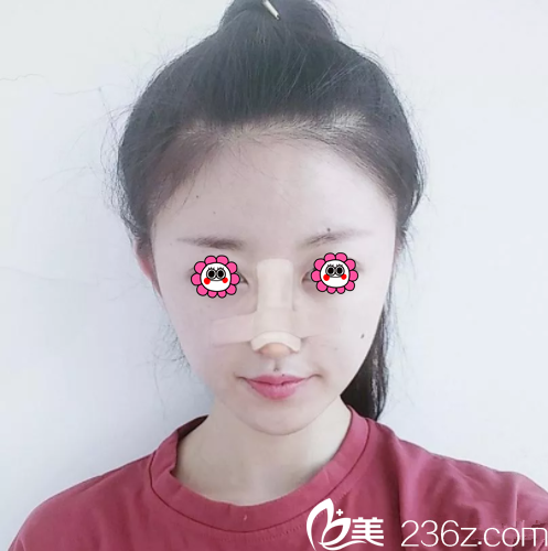 魏傳飛醫(yī)生鼻綜合手術(shù)案例 魏傳飛醫(yī)生鼻綜合手術(shù)案例