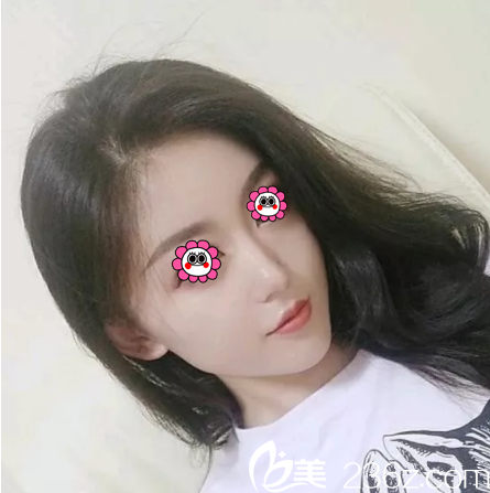 朋友都不支持我做鼻子，不過我還是義無反顧的在贛州薇琳做了鼻綜合手術(shù)，恢復(fù)后的效果給大家看看