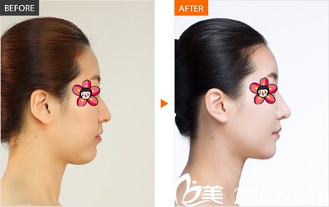 <!--<i data=20240703-sp></i>-->周龍?jiān)洪L(zhǎng)隆鼻<span style= <!--<i data=20240703-sp></i>-->周龍?jiān)洪L(zhǎng)隆鼻<span style=