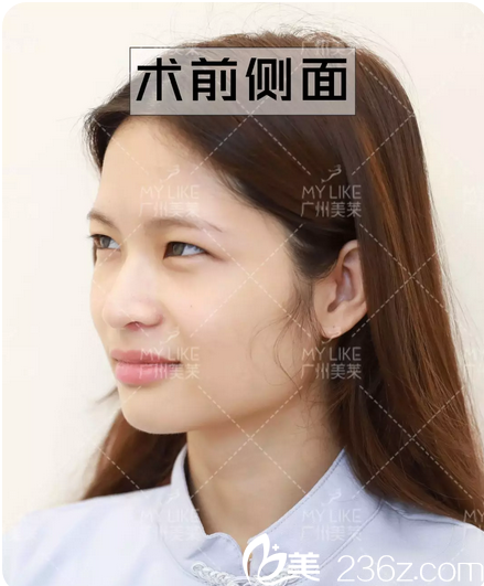 雙眼皮術(shù)前眼皮下垂