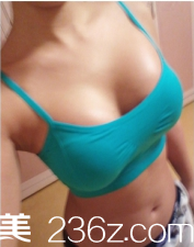 煙臺華怡做的自體脂肪隆胸手術，感覺技術還挺不錯的