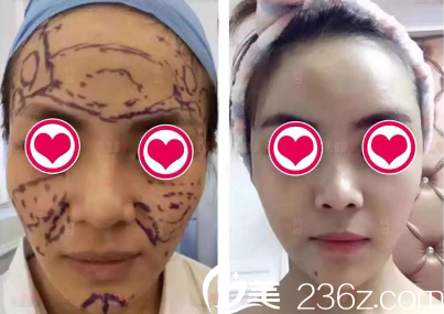 遵義利美康打玻尿酸效果怎么樣？玻尿酸豐蘋果肌太陽穴等案例展示