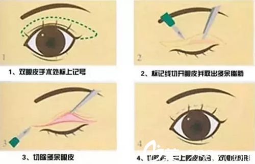 長(zhǎng)春做雙眼皮修復(fù)價(jià)格貴嗎？長(zhǎng)春紅星修復(fù)雙眼皮10800元還你靚麗美眼