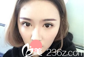 我在德州天宏整形醫(yī)院做的全切雙眼皮手術(shù)，感覺(jué)恢復(fù)的挺不錯(cuò)的