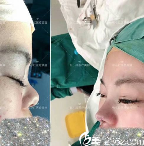 義烏張小紅整形屠昌耀肋軟骨隆鼻實例 義烏張小紅整形屠昌耀肋軟骨隆鼻實例