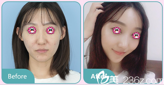 北京藝星醫(yī)療美容醫(yī)院王博謙鼻綜合