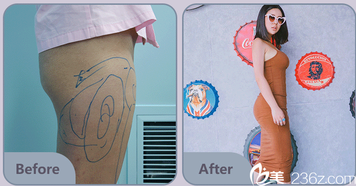 北京藝星腿部吸脂范例