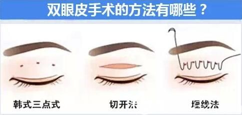 做雙眼皮的三種方法