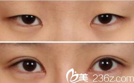做雙眼皮手術(shù)術(shù)前術(shù)后效果對(duì)比