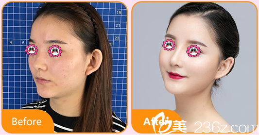 北京藝星慕昕BSK宮廷綜合隆鼻案例 北京藝星慕昕BSK宮廷綜合隆鼻案例