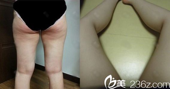 在義烏張小紅醫(yī)療美容醫(yī)院吸脂前 在義烏張小紅醫(yī)療美容醫(yī)院吸脂前