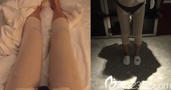 剛做完大腿吸脂的照片 剛做完大腿吸脂的照片