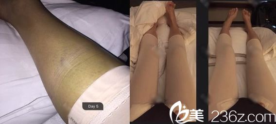 做大腿吸脂手術(shù)5天恢復(fù)<span style= 做大腿吸脂手術(shù)5天恢復(fù)<span style=