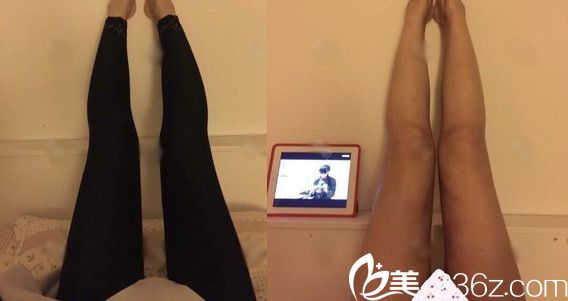 做完大腿吸脂30天恢復(fù)<span style= 做完大腿吸脂30天恢復(fù)<span style=