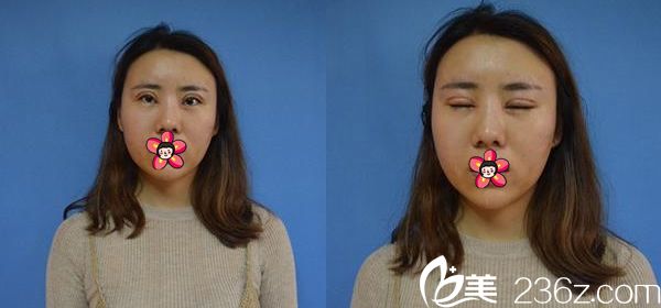 做完雙眼皮和自體脂肪填充7天后