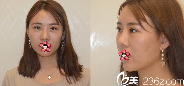 寧波美萊姚遠(yuǎn)雙眼皮脂肪填充案例