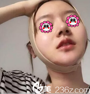 連凱峰醫(yī)生給我做面部吸脂第3天效果