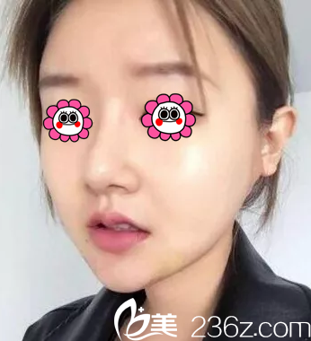 在北京藝星找連凱峰做面部吸脂第21天效果