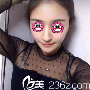 北京藝星連凱峰面部吸脂案例